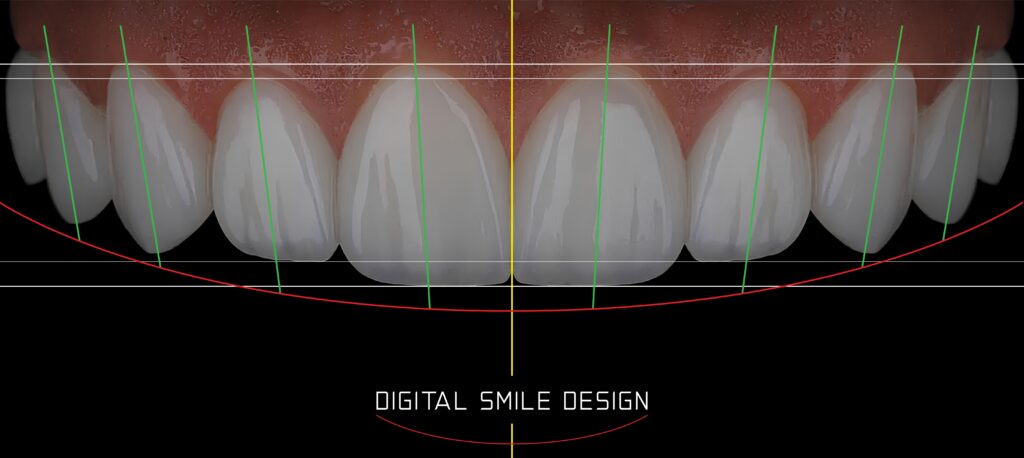 Sorriso harmonioso após tratamento de estética dental com a Dra. Mariela Baltazar no Tatuapé e Mooca