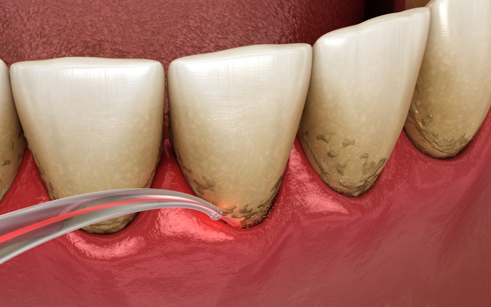 Tratamento de periodontia e limpeza dentária com a Dra. Mariela Baltazar no Tatuapé e Mooca.